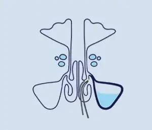 balloon sinuplasty icon