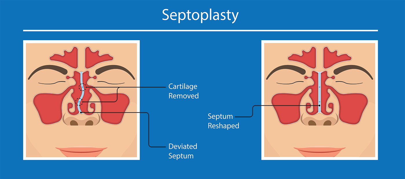 deviated septum surgery illustration